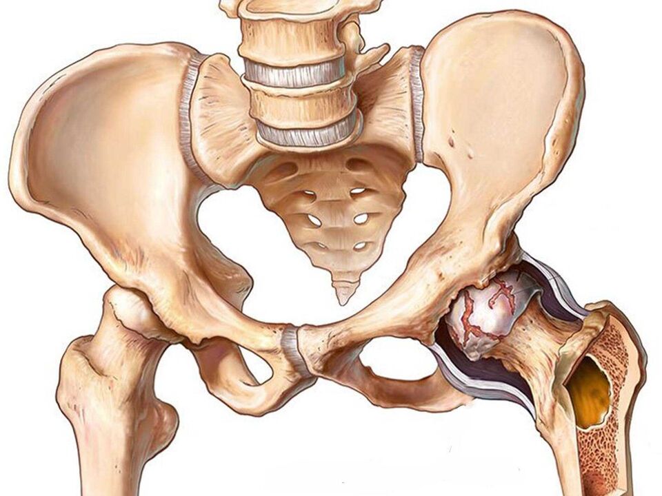 остеоартроз тазобедренного сустава